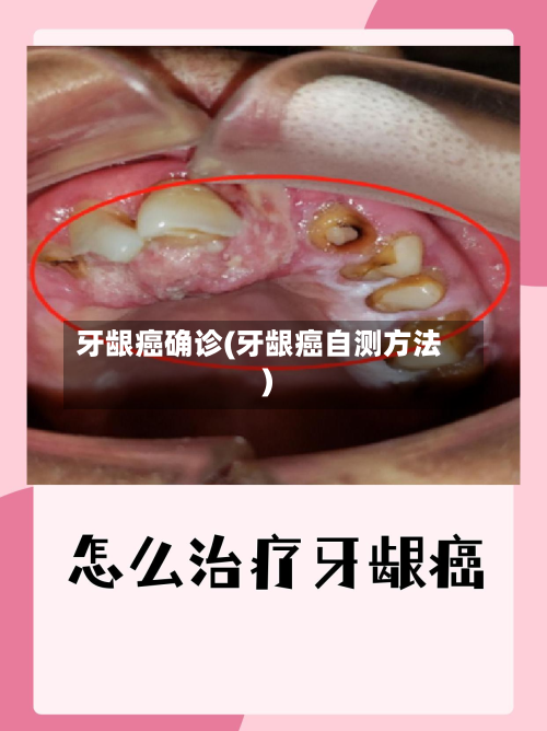 牙龈癌确诊(牙龈癌自测方法)