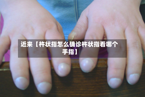 近来【杵状指怎么确诊杵状指看哪个手指】